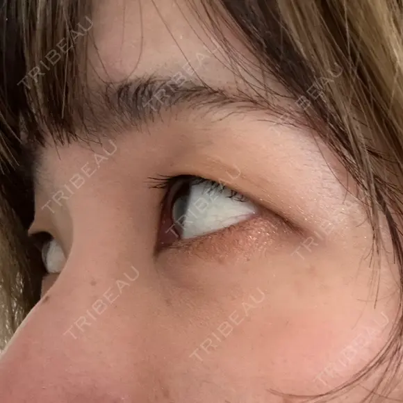 クマ治療 / 脂肪注入（肌） X CLINIC 大阪院 DAY 21 メイン用