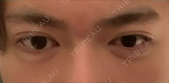 二重埋没 藤・ナチュレ美容クリニック 銀座院 DAY 25 メイン用