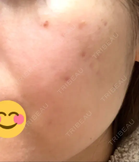 ほくろ・いぼ除去レーザー（肌） / シミ取りレーザー / ピコスポット 日比谷セントラルクリニック DAY 5 メイン用