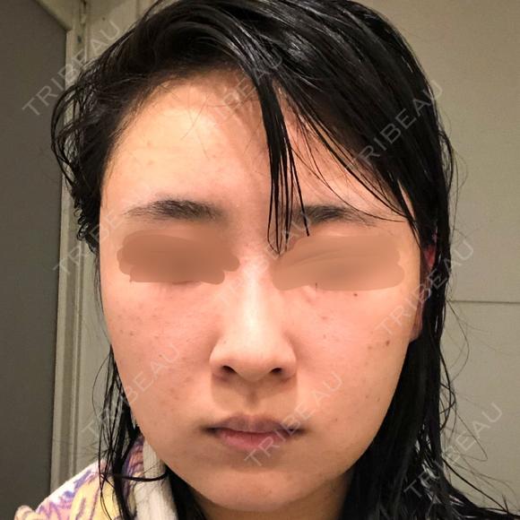 バッカルファット除去 / 脂肪吸引（顔） / ヒアルロン酸注入（鼻） / ボトックス（あご） / 水光注射（ハリ・美肌） / ボトックス（エラ・小顔） / ボトックス（口角） / 白玉点滴・注射 エートップ美容整形外科 DAY 5 メイン用