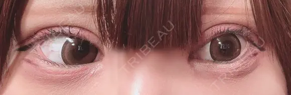 二重切開 / 目頭切開 / 眼瞼下垂（切開） オーキッド美容クリニック東京御徒町 DAY 23 メイン用