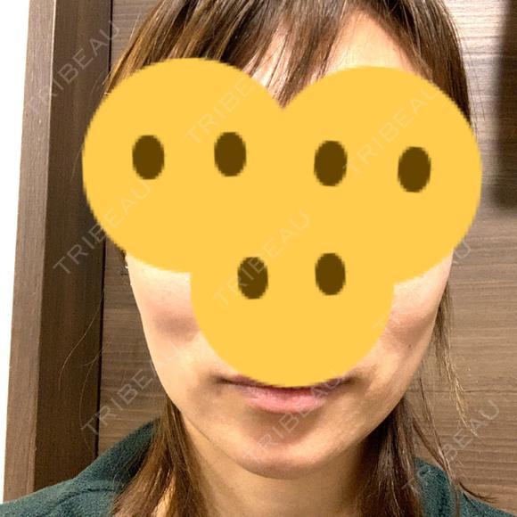 ボトックス（エラ・小顔） Wi Clinic（ウィ クリニック） 吉祥寺院 DAY 8 メイン用