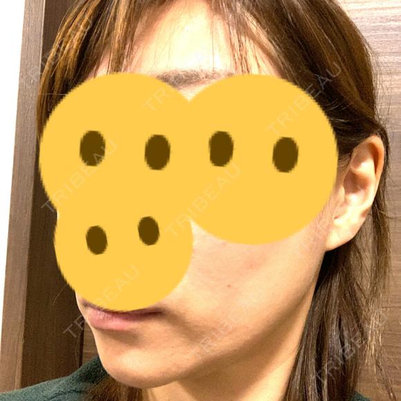 ボトックス（エラ・小顔） Wi Clinic（ウィ クリニック） 吉祥寺院 DAY 8 メイン用