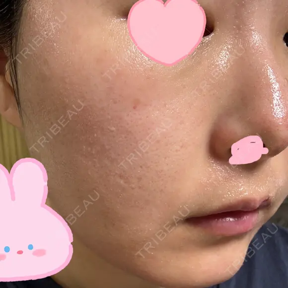 ヴェルヴェットスキン ブリリアスキンクリニック 大宮駅前院 DAY 2 メイン用