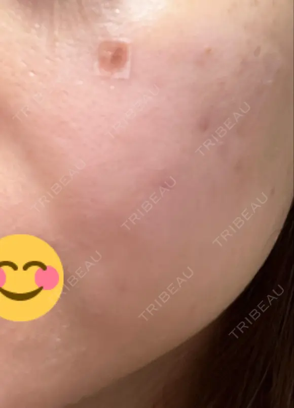 ほくろ・いぼ除去レーザー（肌） / シミ取りレーザー / ピコスポット 日比谷セントラルクリニック DAY 6 メイン用