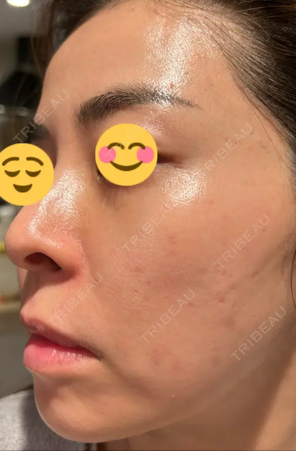 ハイフ（顔） 湘南美容クリニック 高崎院 DAY 16 メイン用