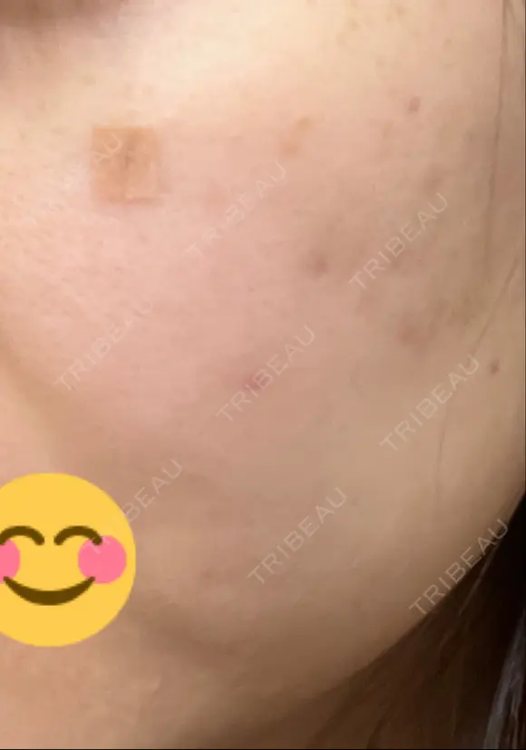 ほくろ・いぼ除去レーザー（肌） / シミ取りレーザー / ピコスポット 日比谷セントラルクリニック DAY 7 メイン用