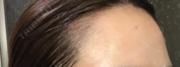 アートメイク（ヘアライン） Tokyo Tensei Clinic 新宿院 DAY 0 メイン用