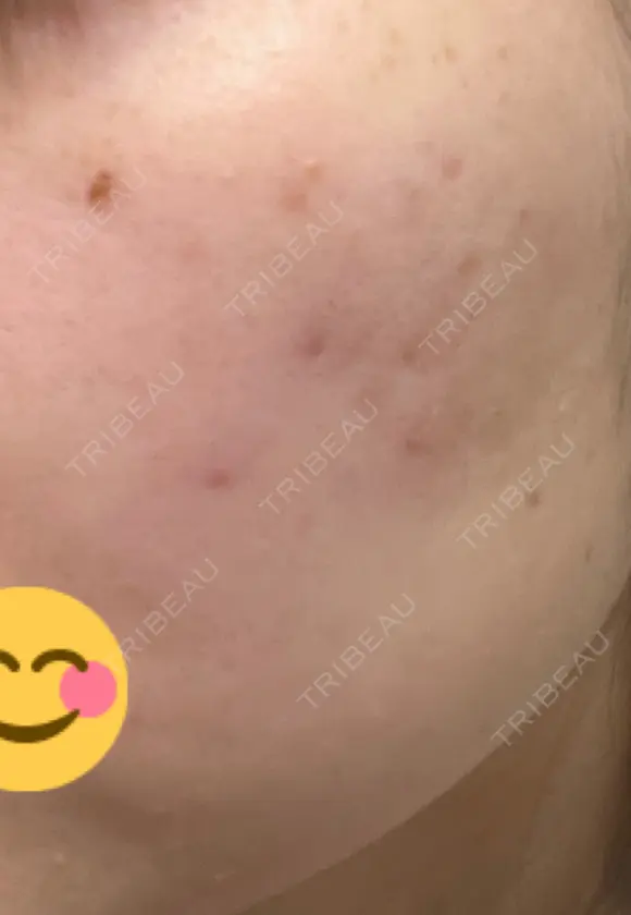 ほくろ・いぼ除去レーザー（肌） / シミ取りレーザー / ピコスポット 日比谷セントラルクリニック DAY 9 メイン用