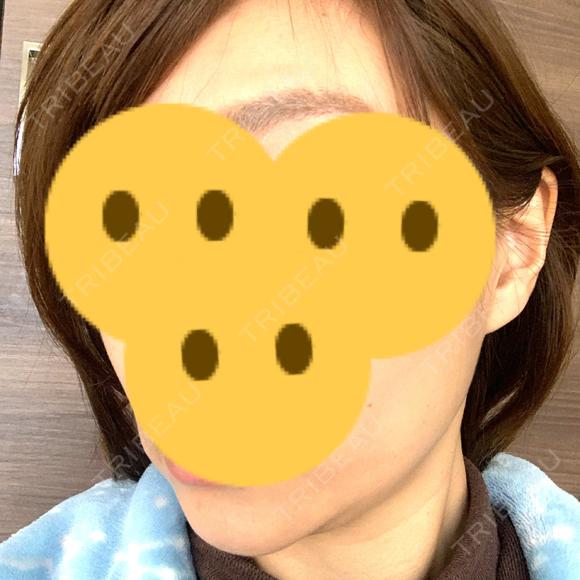 ボトックス（エラ・小顔） Wi Clinic（ウィ クリニック） 吉祥寺院 DAY 12 メイン用