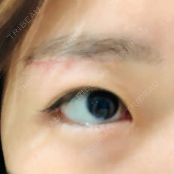 上まぶたの脂肪取り / 眉下切開 THE FIRST CLINIC 多摩センター院 DAY 37 メイン用