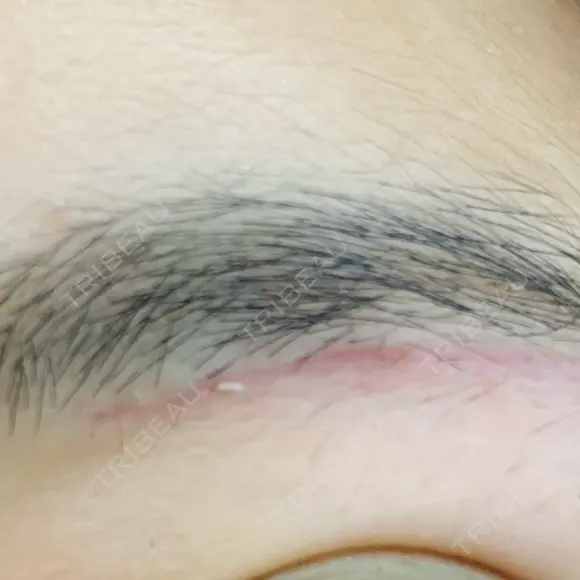 上まぶたの脂肪取り / 眉下切開 THE FIRST CLINIC 多摩センター院 DAY 37 メイン用