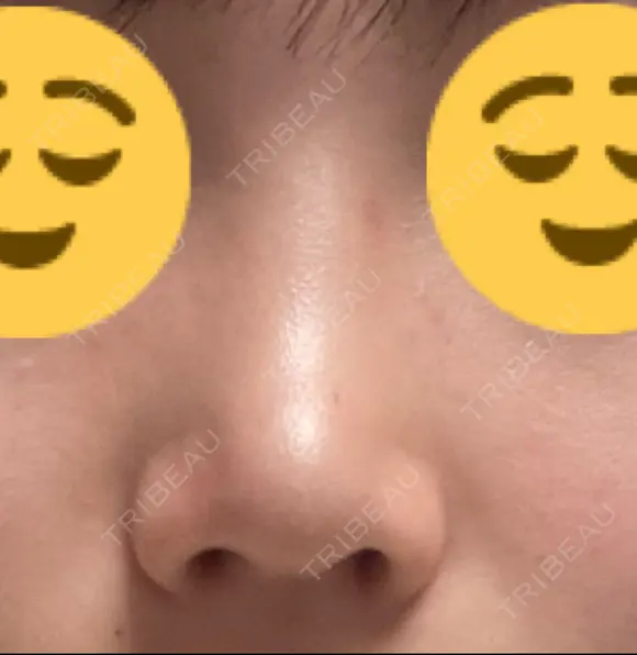 鼻尖形成（切開） / 軟骨移植 / 鼻修正 / 鼻柱下降・鼻唇角形成（猫手術） 東京シンデレラ美容外科 池袋院 DAY 66 メイン用