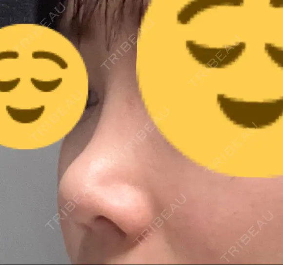 鼻尖形成（切開） / 軟骨移植 / 鼻修正 / 鼻柱下降・鼻唇角形成（猫手術） 東京シンデレラ美容外科 池袋院 DAY 66 メイン用