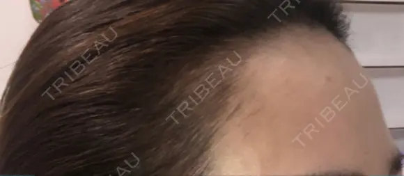 アートメイク（ヘアライン） Tokyo Tensei Clinic 新宿院 AFTER メイン用