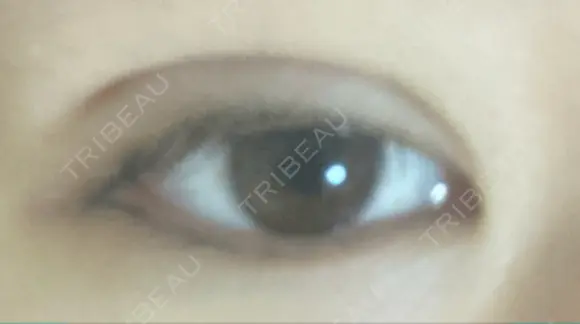 二重埋没 湘南美容クリニック 町田院 DAY 12 メイン用