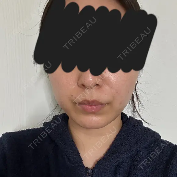 糸リフト / バッカルファット除去 / 脂肪吸引（顔） / メーラーファット除去 / 脂肪吸引注射（顔） SEA CLINIC（シークリニック） AFTER メイン用