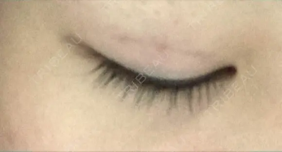 二重埋没 湘南美容クリニック 町田院 DAY 13 メイン用