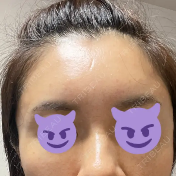 その他（目元） 聖心美容クリニック 六本木院 DAY 4 メイン用