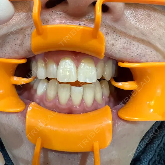 美容点滴・美容注射（ダイエット） / ホワイトニング 麻布シティデンタルクリニック AFTER メイン用