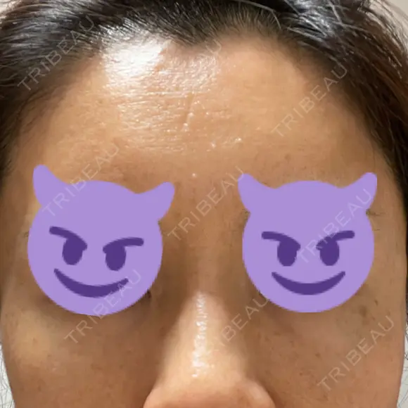 その他（目元） 聖心美容クリニック 六本木院 AFTER メイン用