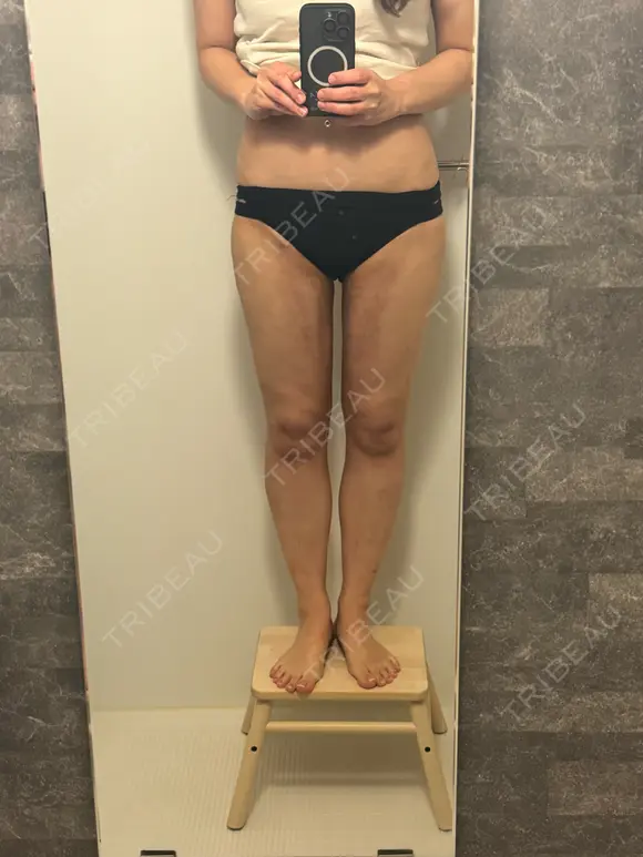 脂肪吸引（脚） 湘南美容クリニック 京都院 DAY 71 メイン用