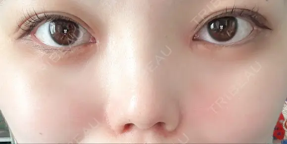 二重埋没 / 目頭切開 / 鼻尖形成（切開） / 軟骨移植 / 眉間プロテーゼ / 鼻尖縮小 グローバルビューティークリニック 大阪院 DAY 40 メイン用