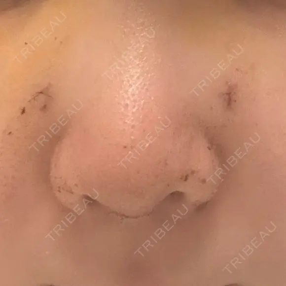 鼻尖形成（切開） / 軟骨移植 / 骨切幅寄せ 9BeautyClinic DAY 4 メイン用