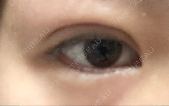 二重埋没 湘南美容クリニック 町田院 DAY 15 メイン用