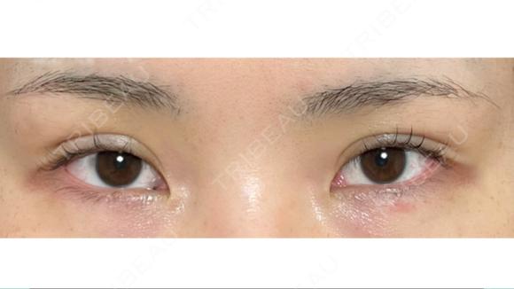 二重埋没 OMI CLINIC 【オミクリニック】 DAY 8 メイン用
