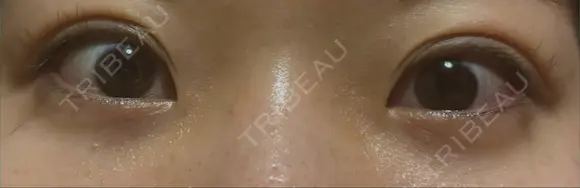 クマ治療 / 下まぶたたるみ取り / 目元修正 / 脂肪注入（目の下） / その他（目元） 吉井クリニック AFTER メイン用