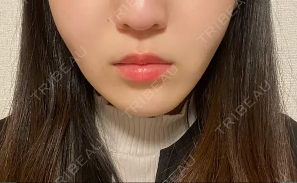 糸リフト / バッカルファット除去 / 脂肪吸引（顔） EMMA CLINIC（エマクリニック） DAY 91 メイン用