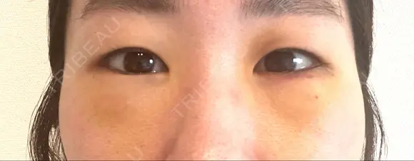 下まぶたの脂肪取り / ボトックス（あご） シェリークリニック 新宿本院 DAY 4 メイン用