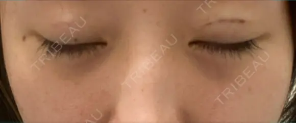 二重埋没 / ヒアルロン酸注入（涙袋） Olino美容外科・美容皮膚科 DAY 40 メイン用