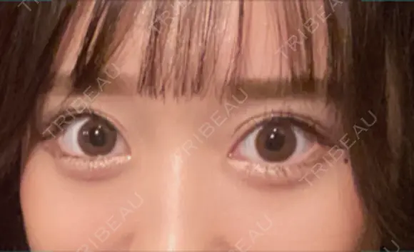 二重埋没 / ヒアルロン酸注入（涙袋） Olino美容外科・美容皮膚科 AFTER メイン用