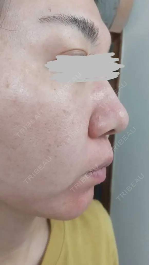 ポテンツァ 9BeautyClinic DAY 1 メイン用
