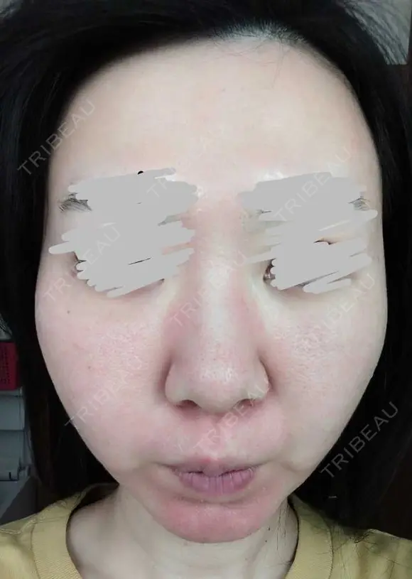 ポテンツァ 9BeautyClinic AFTER メイン用