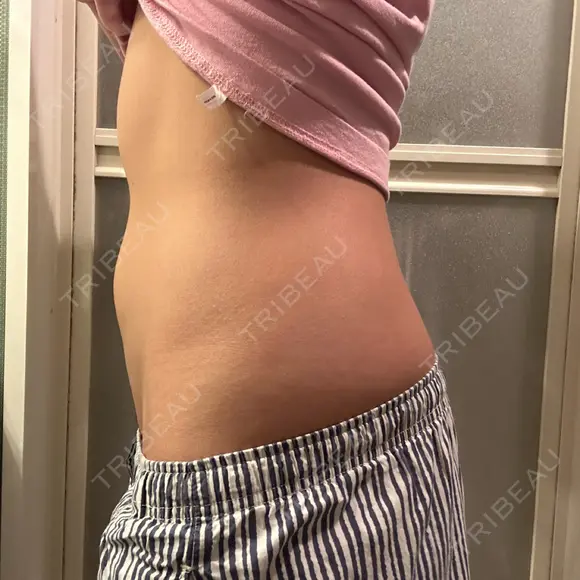 医療痩身（お腹） 湘南美容クリニック 博多院 AFTER メイン用