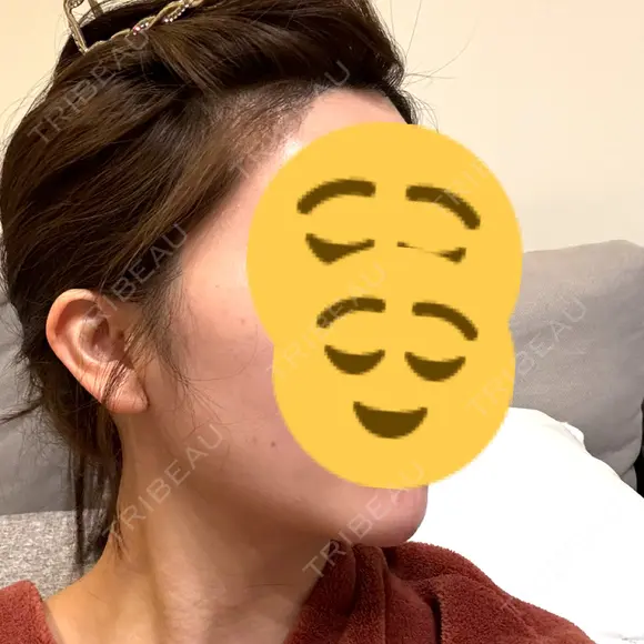 糸リフト / 脂肪吸引注射（顔） 湘南美容クリニック 吉祥寺院 DAY 21 メイン用