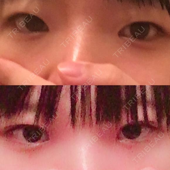 二重切開 / 上まぶたの脂肪取り 聖心美容クリニック 横浜院 DAY 20 メイン用