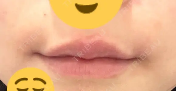 ヒアルロン酸注入（涙袋） / ヒアルロン酸注入（唇） 東京シンデレラ美容外科 大宮院 DAY 0 メイン用