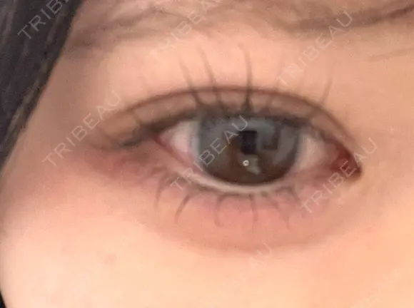 ヒアルロン酸注入（涙袋） / ヒアルロン酸注入（唇） 東京シンデレラ美容外科 大宮院 DAY 0 メイン用