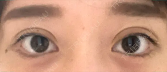 二重埋没 / ヒアルロン酸注入（涙袋） Olino美容外科・美容皮膚科 DAY 10 メイン用
