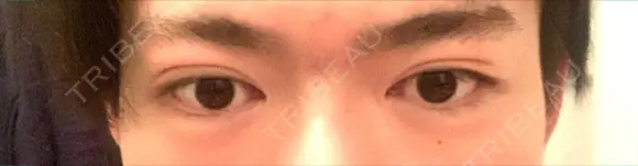 二重埋没 藤・ナチュレ美容クリニック 銀座院 DAY 37 メイン用