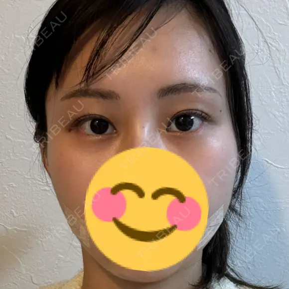 ボトックス（目尻） TCB東京中央美容外科 梅田茶屋町院 DAY 56 メイン用