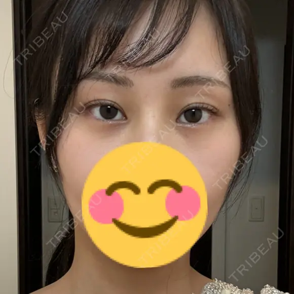 ボトックス（目尻） TCB東京中央美容外科 梅田茶屋町院 DAY 87 メイン用