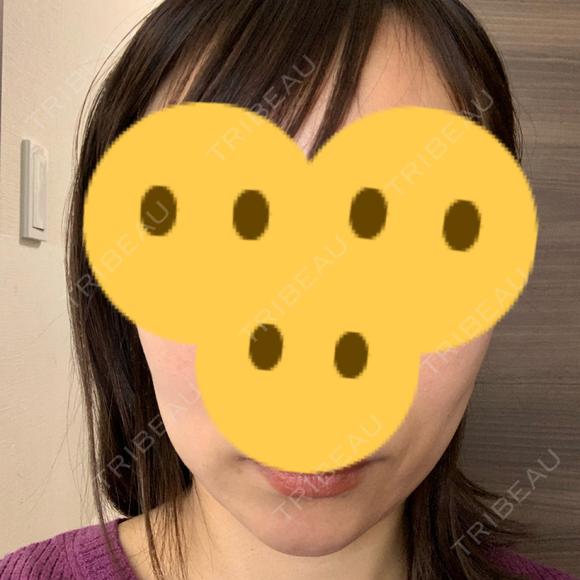 ボトックス（エラ・小顔） Wi Clinic（ウィ クリニック） 吉祥寺院 AFTER メイン用