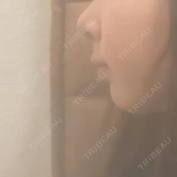 鼻尖形成（切開） / 軟骨移植 / 骨切幅寄せ 9BeautyClinic DAY 8 メイン用