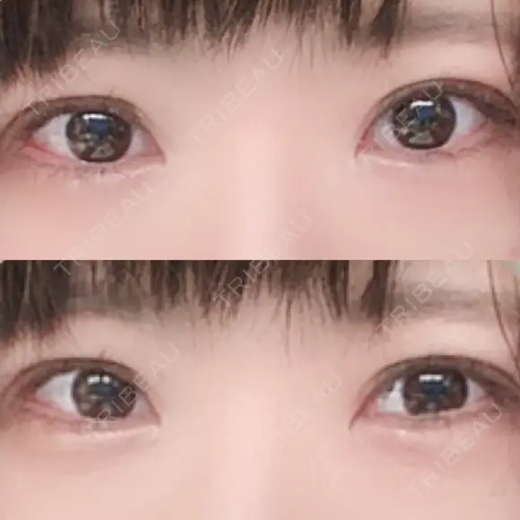 二重切開 / 目元修正 ルネッサンス美容外科医院 神戸院 DAY 82 メイン用