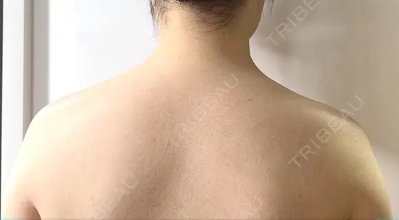 ボトックス（エラ・小顔） / ボトックス（口角） / ボトックス（肩） M'sクリニック【エムズクリニック】 AFTER メイン用